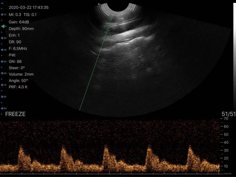 Wireless Color Doppler Transvaginal Ultrasound Scanner TRC scan result