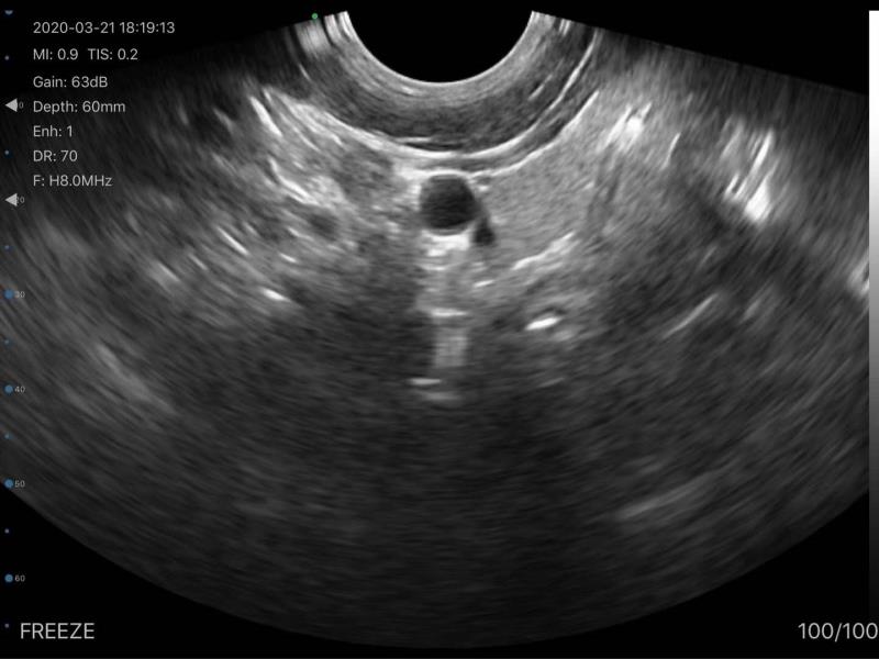 Wireless Transvaginal Ultrasound Scanner Color Doppler FDA TRC scan result